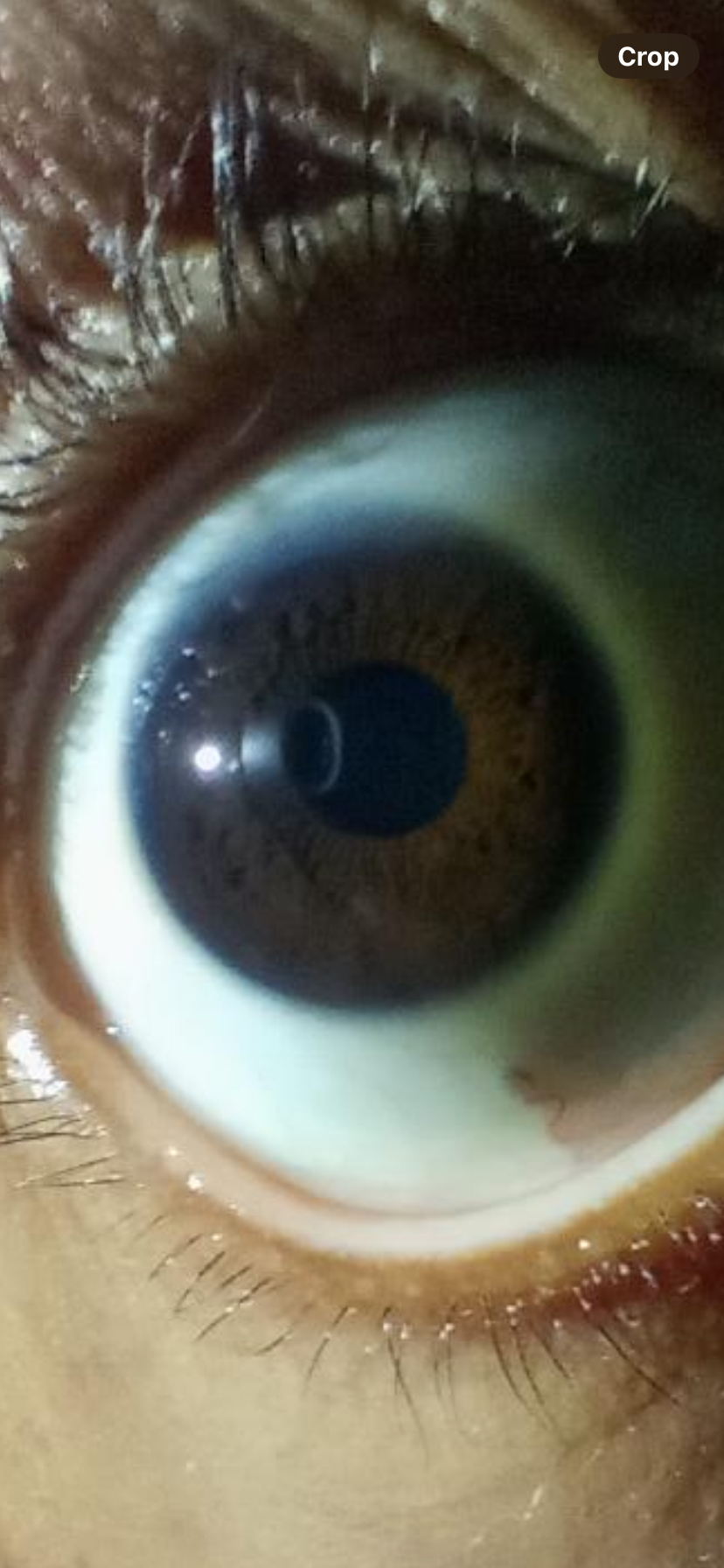 Iridology Screening